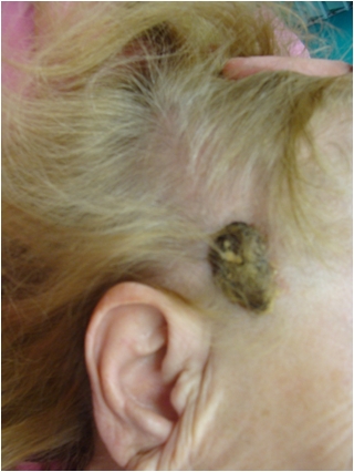 Skin cancer of the temporal region -after 6 months